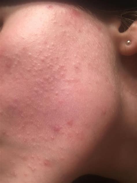 Small Flesh Colored Bumps On Cheeks General Acne Discussion