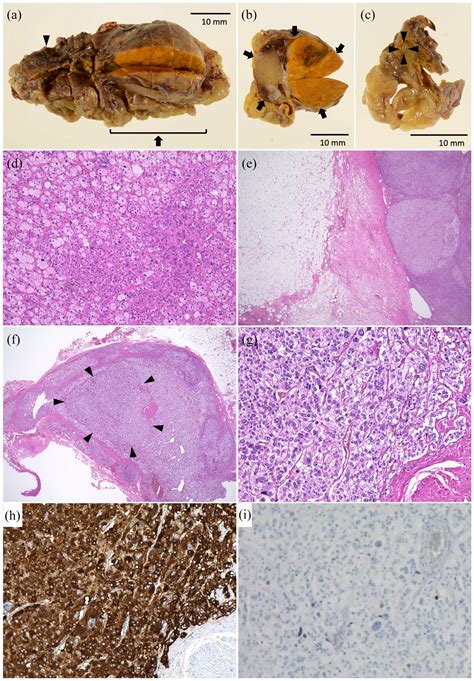 A Cortisol Secreting Adrenal Adenoma Combined With A Micro