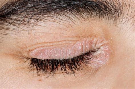 Psoriasis On The Eyelids Symptoms Causes And Treatment