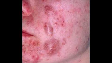 What Is Cystic Acne How To Treat Cystic Acne Answers Youtube