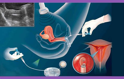 Intrauterine Insemination Iui Advanced Fertility Centers