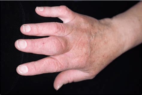 A Photograph Showing An Acute Arthritis Phase In The Proximal