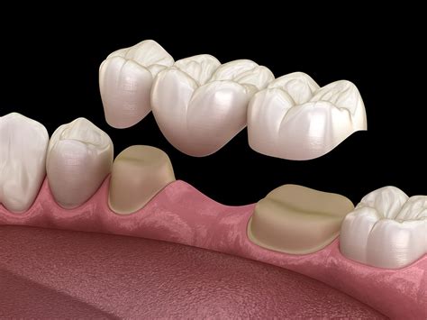 Dental Bridge Will Bridge The Gap Created By One Or More Missing Teeth