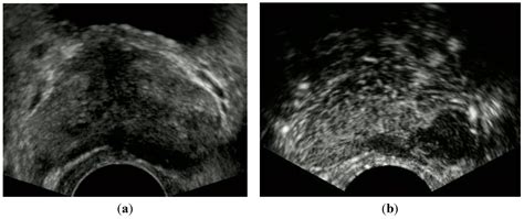 Transrectal Ultrasound Of Prostate