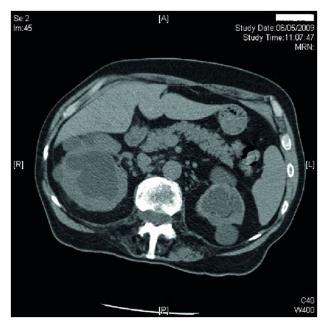 Computed Tomography Of Abdomen Revealed Marked Right Hydronephrosis And