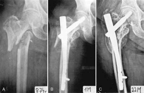 Subtrochanteric Fractures Intramedullary Fixation Musculoskeletal Key