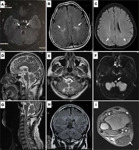 Magnetic Resonance Imaging Mri Findings In Patients With Spastic