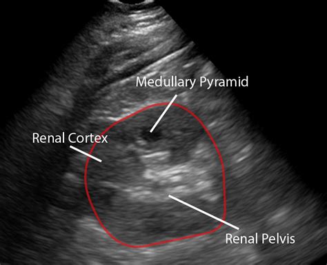 Normal Renal Ultrasound