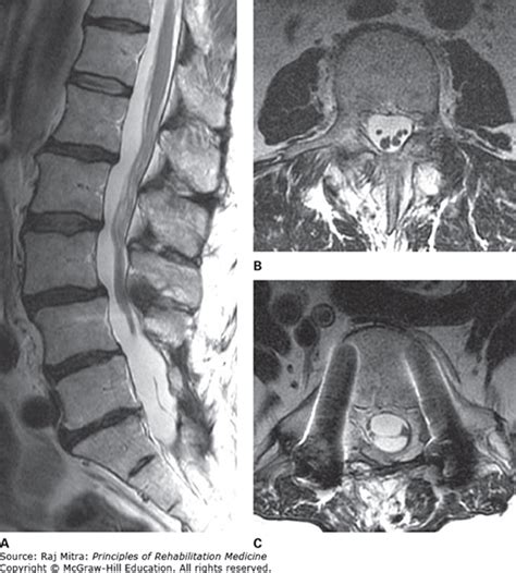 Spinal Cord Injury Infectious And Inflammatory Etiologies