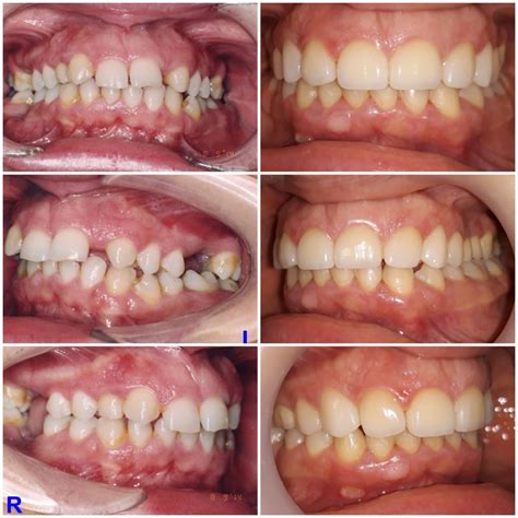 Lateral Incisors Anodontia Dental Implants Sinsus Lift