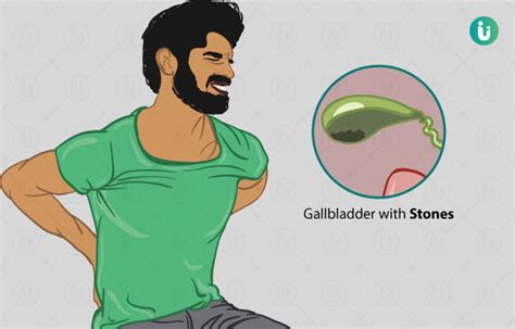 Gallbladder Stones Symptoms Causes Treatment Medicine Prevention