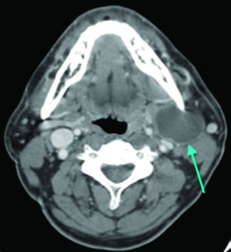 The Growing Epidemic Of Hpv Positive Oropharyngeal Carcinoma A
