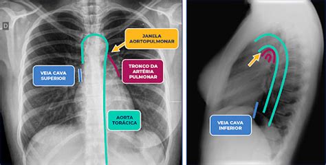 Anatomia Radiogr Fica Do Cora O E Dos Vasos Da Base Medway