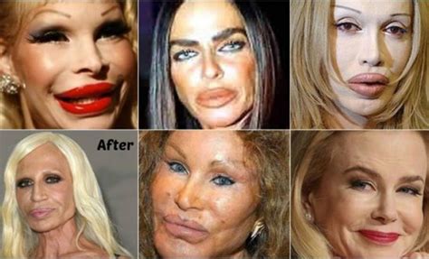 Horrorosos Casos De Botox En Famosas FAILS Vibra