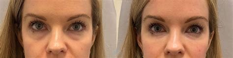 Juvéderm® And Restylane® Before And After Pictures Case 31 Charlotte