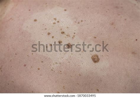 Seborrheic Keratosis On Human Skin Before Stock Photo 1870033495