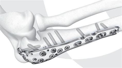 Lcp® Olecranon Plates 35 Mm Depuy Synthes