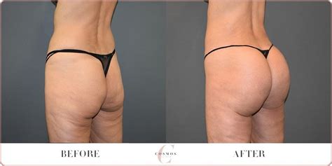 Brazilian Buttock Augmentation Before After Learn More