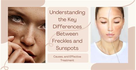 Understanding The Key Differences Between Freckles And Sunspots Clinikally