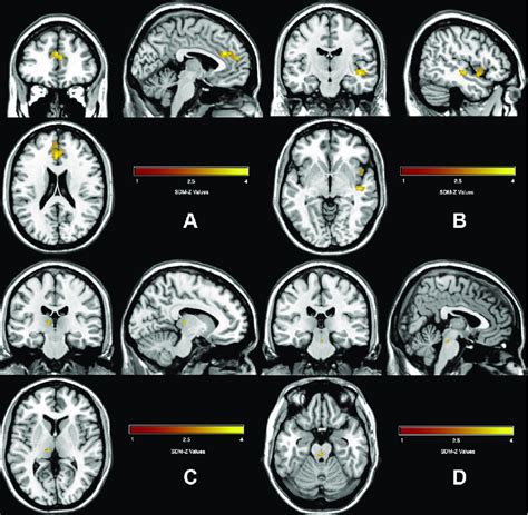 Gray Matter Alterations Found In Obsessive Compulsive Disorder Group