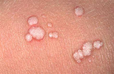 Common Warts Medical Pictures Info Health Definitions Photos