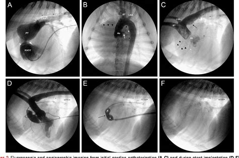 Figure 2 From Transpulmonary Stent Implantation For Dysplastic