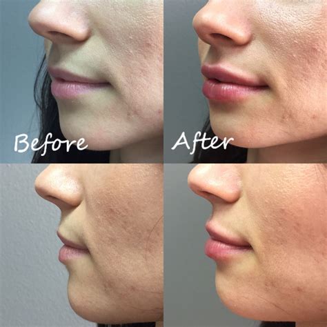 Vollure Lip Filler Before And After Before And After