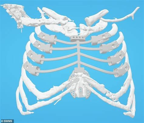 Uk Patient Becomes Sixth Person In The World Fitted With 3d Printed Rib