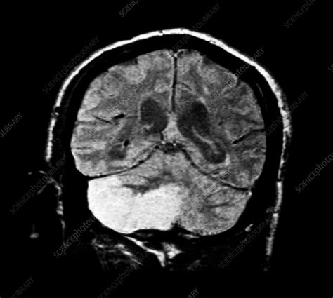 Mri Of A Cerebellar Infarction Stock Image M1360325 Science