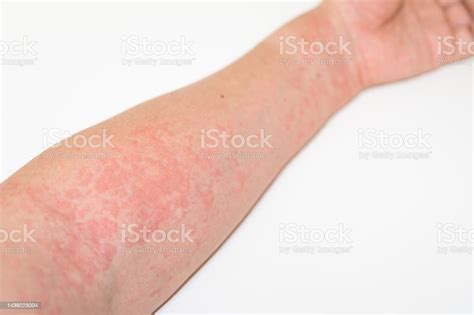 Hives On Arm Stock Photo Download Image Now Hives Skin Condition