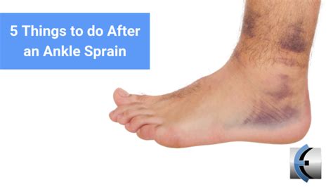 Top 5 Fridays 5 Things To Do After An Ankle Sprain Sprained Ankle