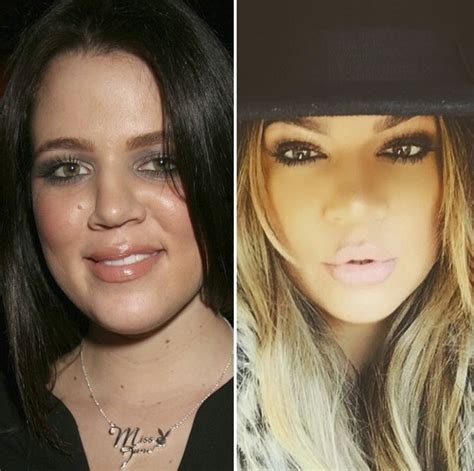 Khloe Kardashian Before And After Plastic Surgery 05 Celebrity
