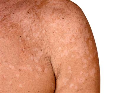 Tinea Versicolor Dermatology And Plastic Surgery In Palm Desert Ca