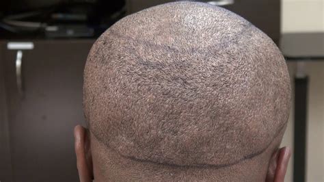 Hair Transplant Fue Donor Scar Results Men Hair Loss Fix By Dr Diep