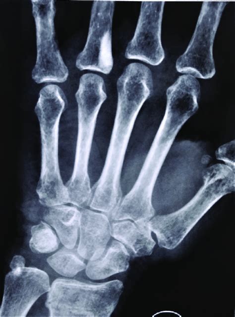 Radiograph Showing A Dense Sclerotic Lesion On Fourth Proximal Phalanx
