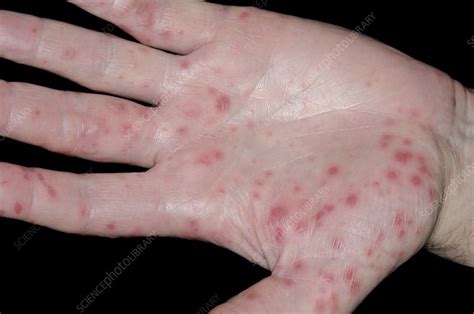 Hand Foot And Mouth Disease Stock Image C0147980 Science Photo