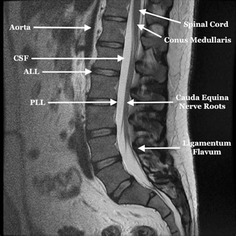 Evaluation And Management Of Cauda Equina Syndrome The American