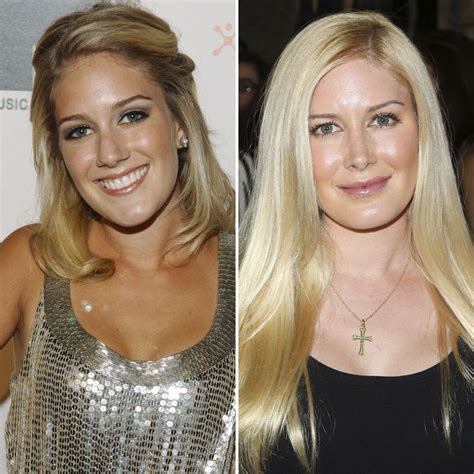 Top Pictures Heidi Montag Before After Plastic Surgery Pictures Excellent