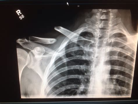 Recently Crashed Here Is How My Fractured Clavicle Collarbone