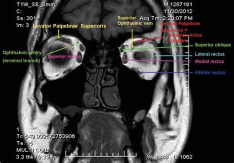 Orbit Mri Anatomy Radiology Anatomy Images