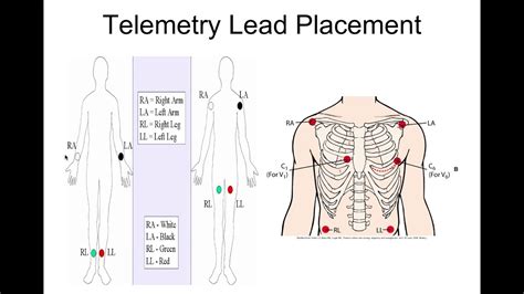 The Gallery For Telemetry Monitoring Lead Placement