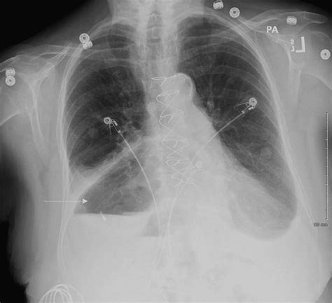Chest X Ray In The Pa View Showing A Large Hiatal Hernia With Gaseous