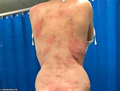 Mum Left With Painful Burn Like Rashes All Over Her Body After A