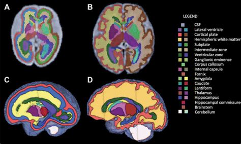 Normal Growth Sexual Dimorphism And Lateral Asymmetries At Fetal Brain Mri Radiology