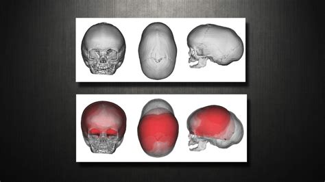 Craniosynostosis Virtual Cranial Vault Skull Reconstruction