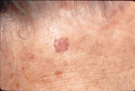 Examples Of Skin Cancer Spots