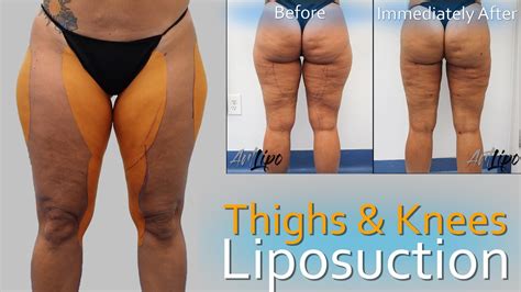 Lipo Legs Thigh Knee Liposuction Lipedema Surgery Expert Dr