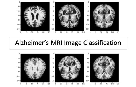 Alzheimers Mri Image Classification Journey To Data Scientist