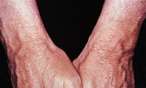 Flesh Colored Papules On The Wrists Of A 61 Year Old Man—quiz Case