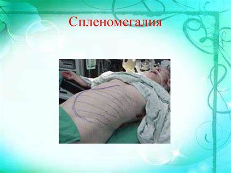 Спленомегалия лечение диета